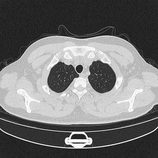 1668507747493875.gif 01-入院前2周时CT-优化216.gif