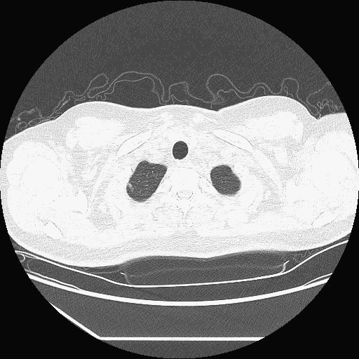 1668507802649995.gif 02-入院时CT.gif