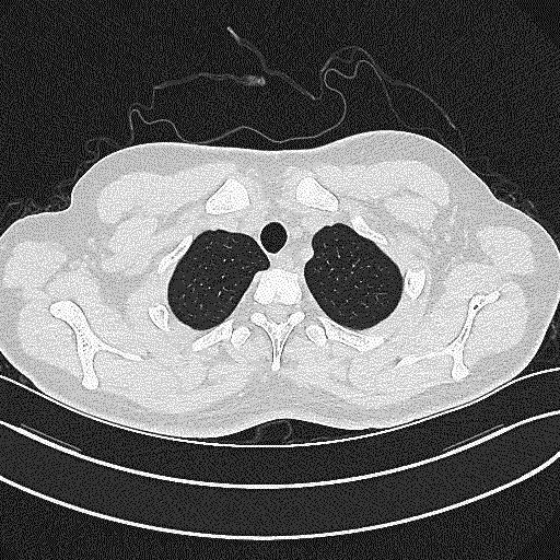 1668507854777799.gif 07-入院第19天CT-优化.gif