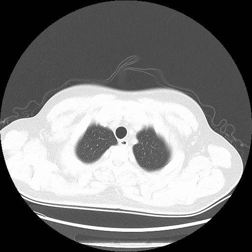 1668507869837570.gif 10-出院后2周CT.gif