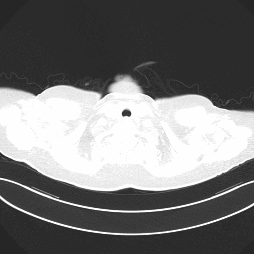 附图3 患者入院后第9天胸部CT（2021-06-21）.gif