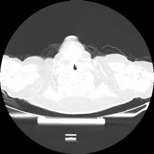 附图4 患者入院3周后胸部CT（2021-07-05）.gif