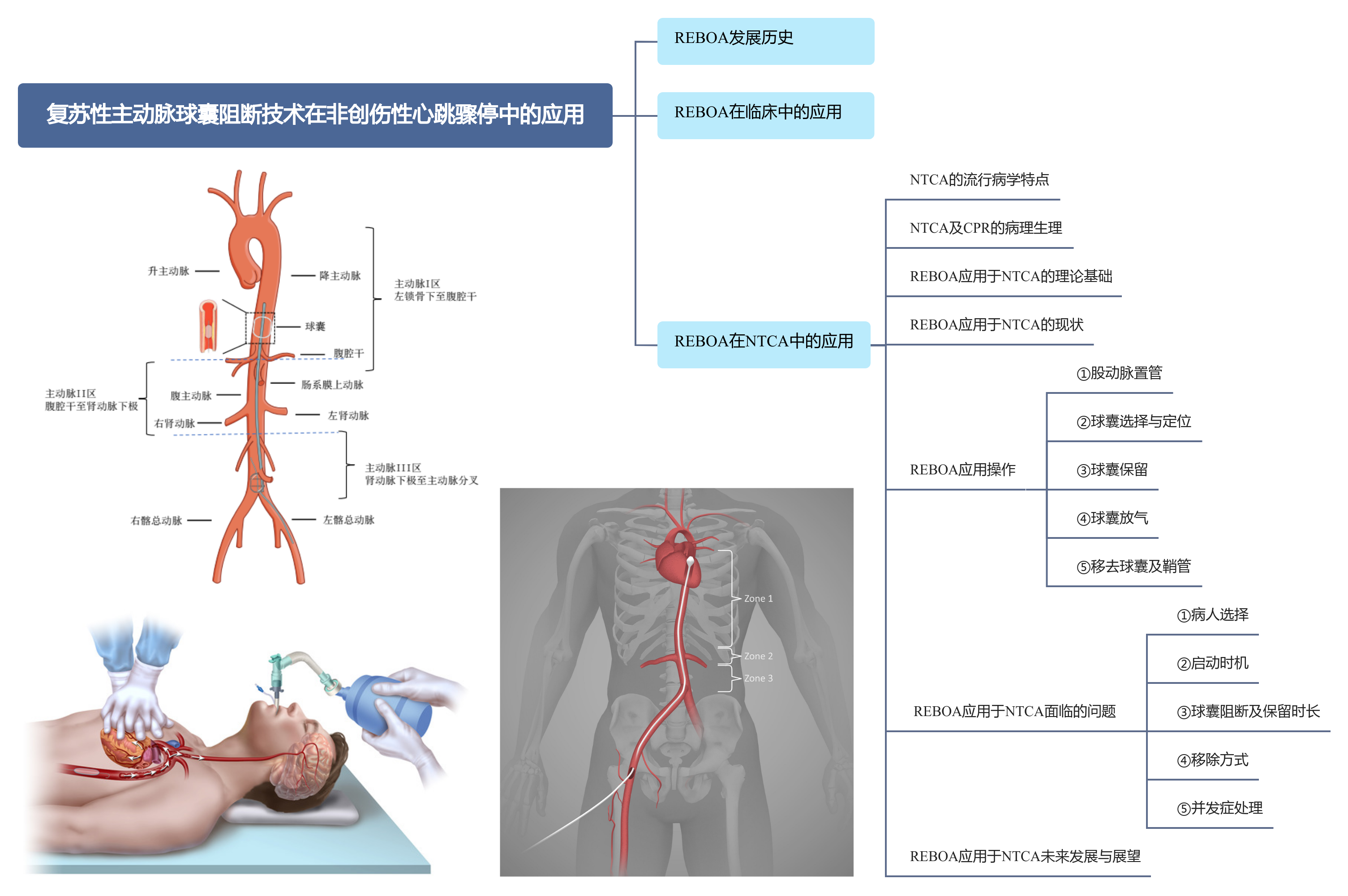 复苏性主动脉球囊阻断技术在非创伤性心跳骤停中的应用_思维导图.png