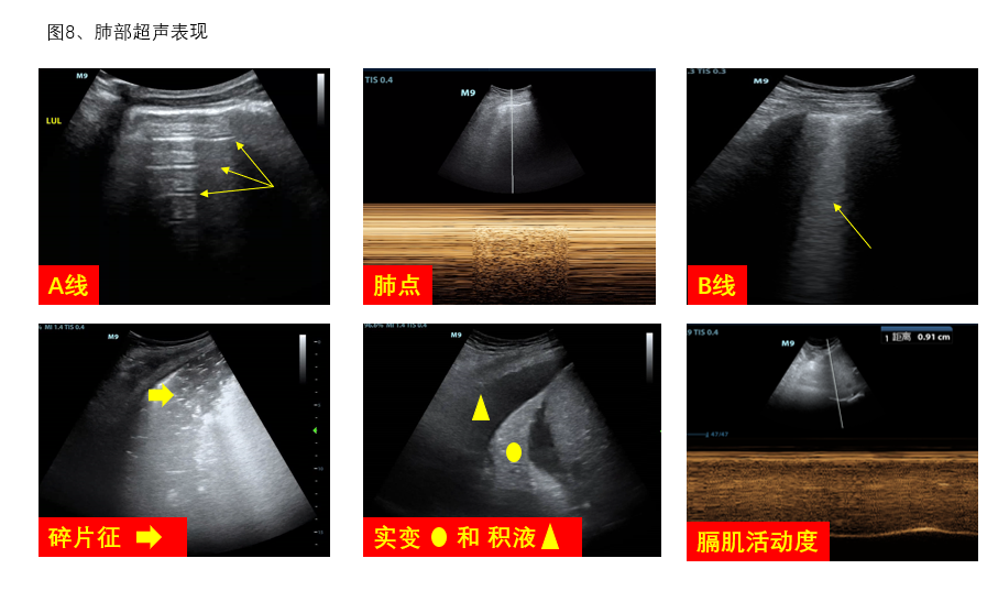 图8 肺部超声 表现
