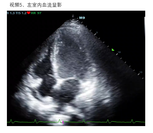 视频5 左室内血流显影