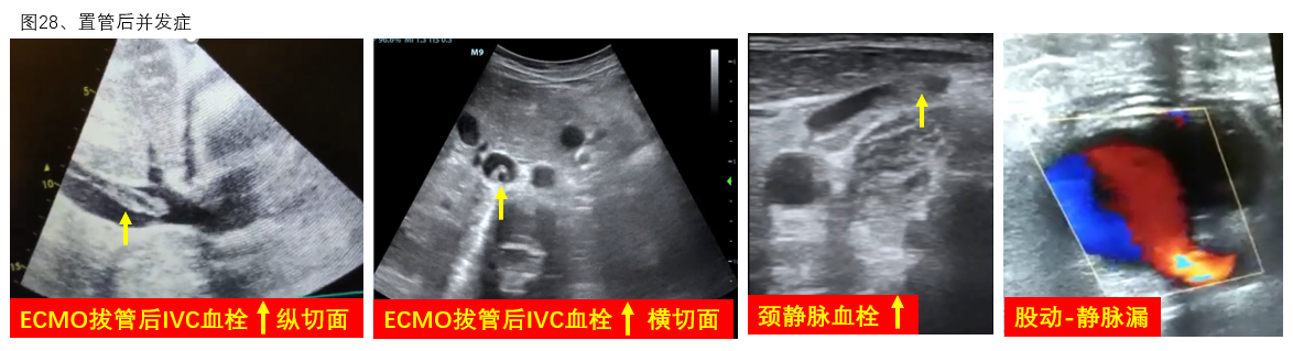 图28 置管后并发症